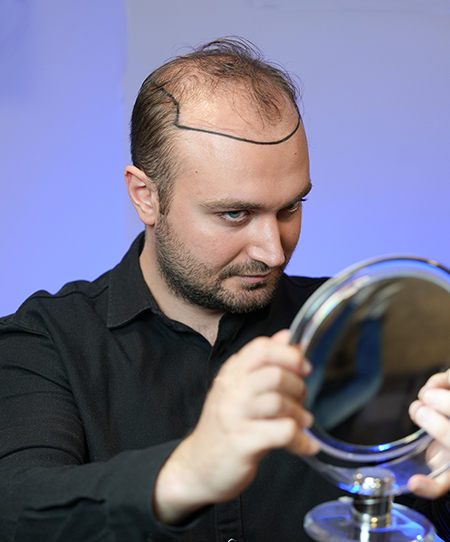8 Reasons to Choose Turkey for Hair Restoration