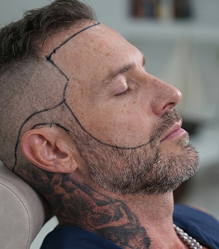 Beard Grafts