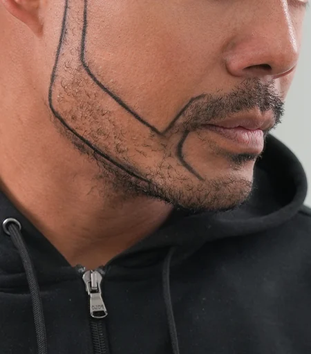 Beard & Mustache Transplant