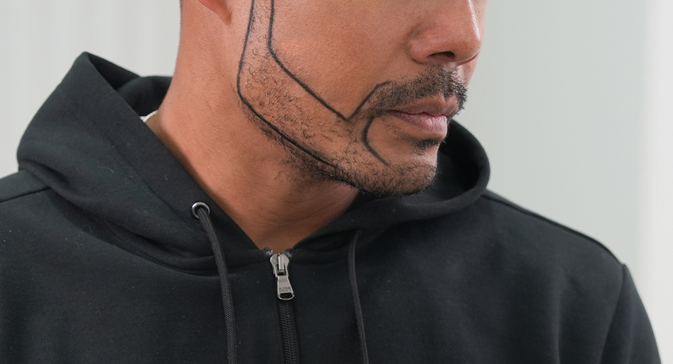 Beard & Mustache Transplant